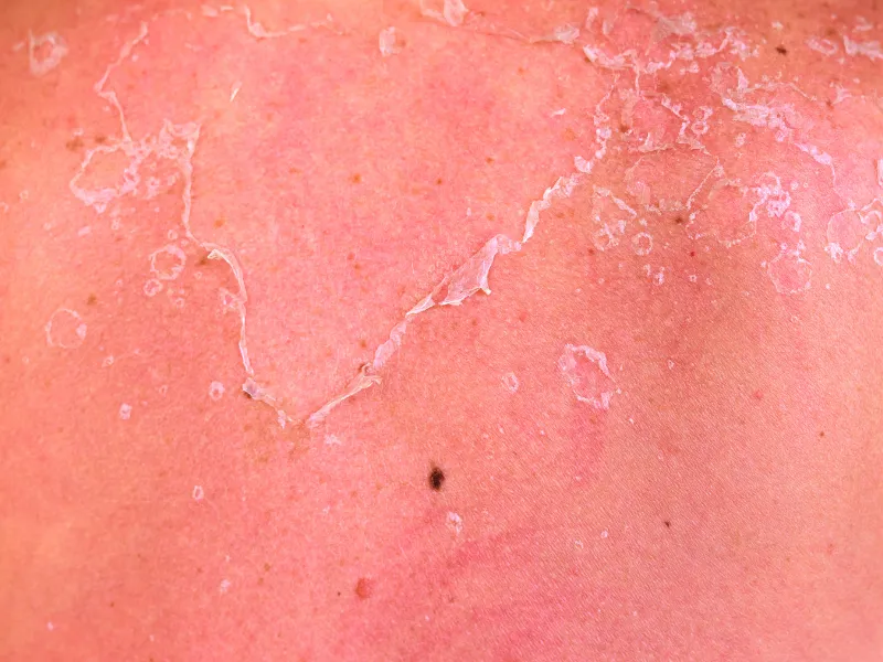 Sonnenbrand